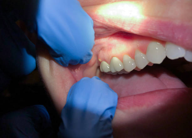 Best Emergency Wisdom Tooth Extraction in Stem, NC